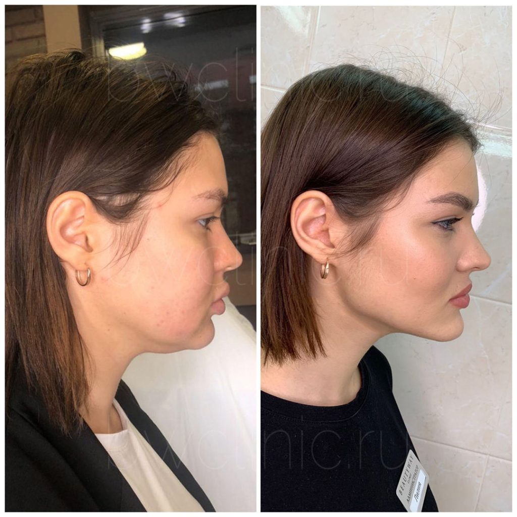 Kybella Before and After: How to Maximize Your Aesthetic Outcome